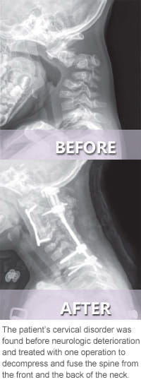 cervical-spine-visual-before-after-200x